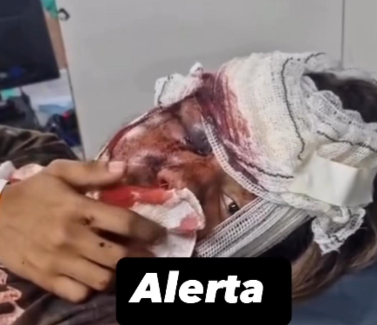 Violência brutal: Juliana é espancada por ciúmes e precisa de cirurgia no rosto